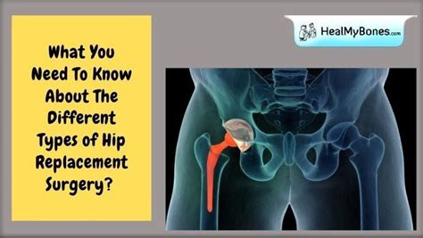 What You Need To Know About The Different Types of Hip Replacement Surgery? in 2021 | Hip ...