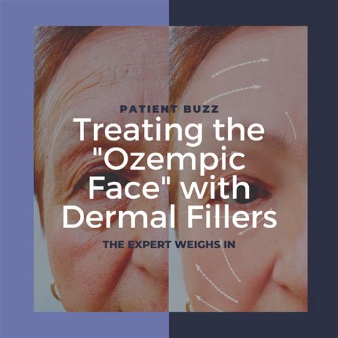 Treating the "Ozempic Face" with Dermal Fillers - Next Steps in Dermatology