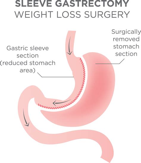 Gastric Sleeve Surgery Near Johnstown and Windber - Chan Soon-Shiong ...