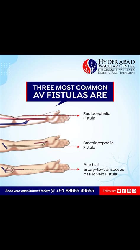 Three most common AV Fistulas are Radiocephalic Fistula, Brachiocephalic Fistula and Brachial ...