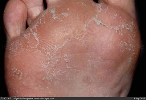 STOCK IMAGE, juvenile plantar dermatosis on the foot of an eleven year old female patient ...