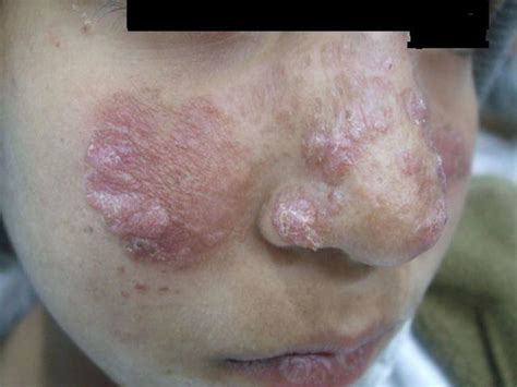 Cutaneous, visceral & mucocutaneous leishmaniasis symptoms & treatment