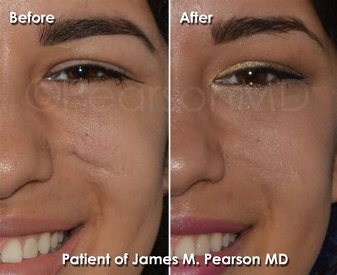 Scar Revision Photos - Before & After - Dr. James Pearson Facial Plastic Surgery