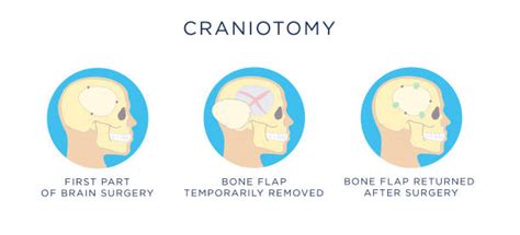 Craniotomy Pics Illustrations, Royalty-Free Vector Graphics & Clip Art - iStock