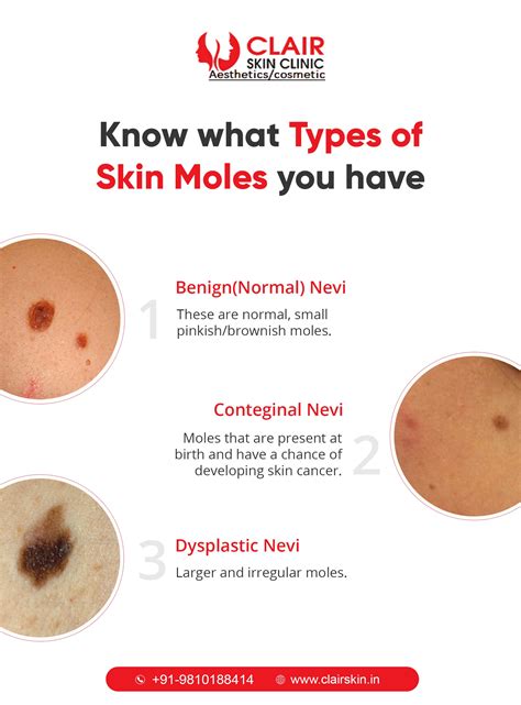 Skin Moles Types