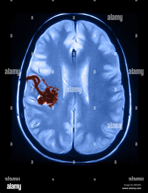 Arteriovenous Malformation Chantelle