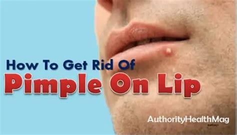 Pimple On Lip Swollen Painful Bump Get Rid Of Lip Pimple Treatment | My XXX Hot Girl