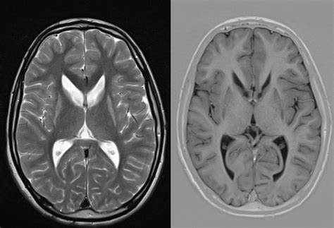 Radiology MRI: Huntington Disease