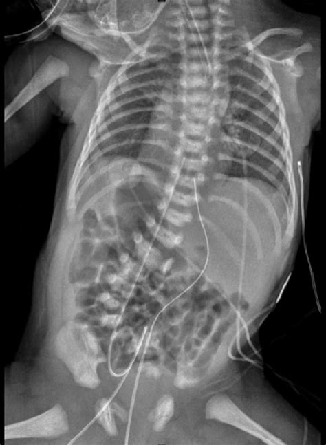 Plain radiograph showing abdominal situs inversus and dextrocardia. | Download Scientific Diagram