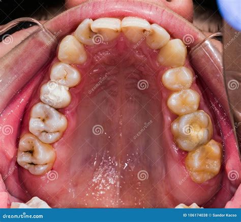 Human decaying teeth stock photo. Image of gingivitis - 106174038