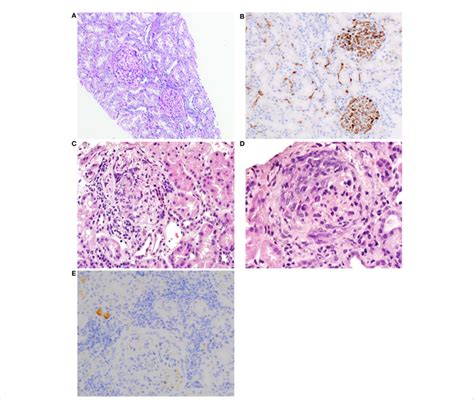 (A) First kidney biopsy. PAS staining of the cortex shows normal to... | Download Scientific Diagram