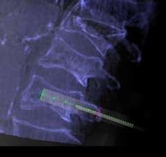 Vertebroplasty / Kyphoplasty / Sacroplasty - Interventional ...