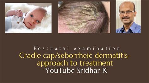 Cradle cap. Seborrhoeic dermatitis. Approach to treatment of cradle cap ...