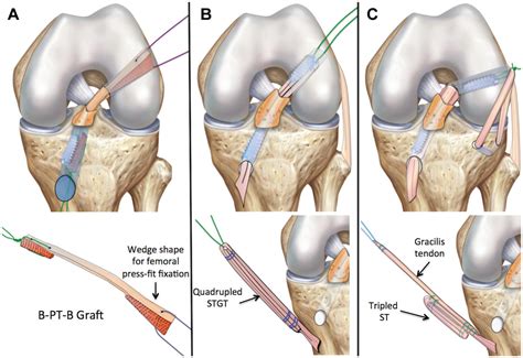 Patellar Tendon Graft