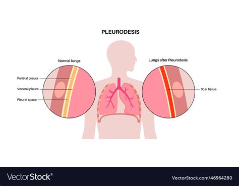 Pleurodesis medical procedure Royalty Free Vector Image