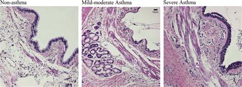 Histology of a representative airway of an individual who died of... | Download Scientific Diagram