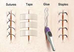 Krames Online - Caring for Your Child’s Incision