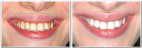 What is the Zoom Whitening Procedure?: Before and After Zoom Whitening for Teeth