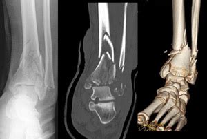Fracture Of Tibial Plafond