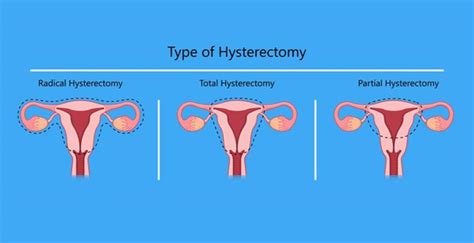 Hysterectomy A-Z: Why, When, How And What After By Joe Kabyemela Ebook Scribd | lupon.gov.ph