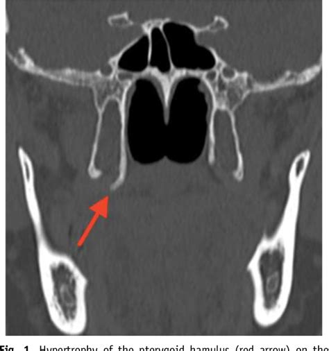 Figure 1 from Pterygoid hamulus syndrome: a case report | Semantic Scholar