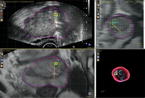 MR/ultrasound fusion guided biopsy of the prostate: a better way to biopsy the prostate | CK Ng ...