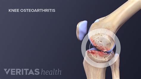 Crepitus in the Knee | Arthritis-Health