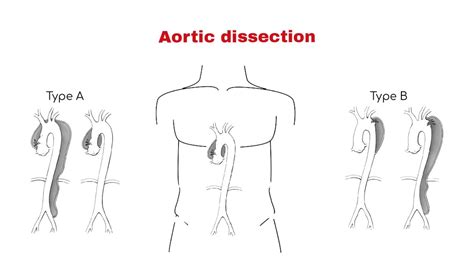 Aortic dissection ~ Chest Pain