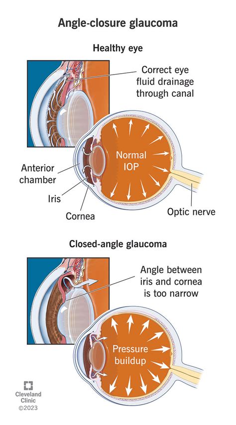 Angle-Closure Glaucoma: Symptoms & Treatment