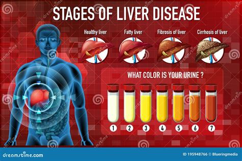 Stages of liver disease stock vector. Illustration of healthy - 195948766