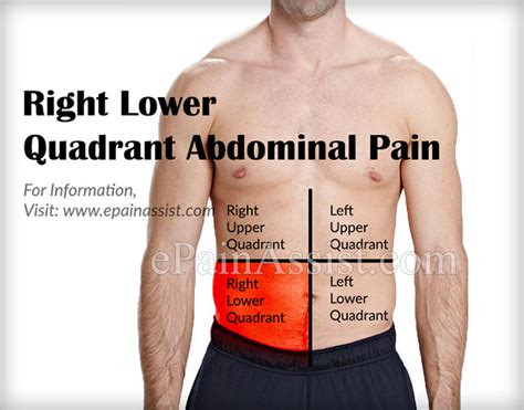 What Can Cause Right Lower Quadrant Abdominal Pain & How is it Treated?