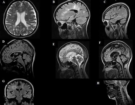 Axial T2 brain MRI showing bilateral periventricular white matter... | Download Scientific Diagram