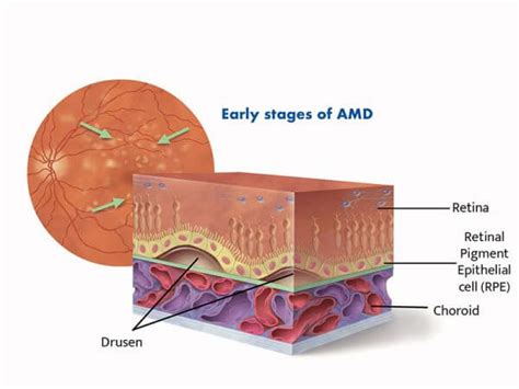 AMD Awareness Month: 5 Useful Tips to Prevent AMD - Vision Eye Health