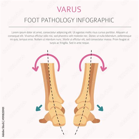 Foot deformation as medical desease infographic. Valgus and varus ...