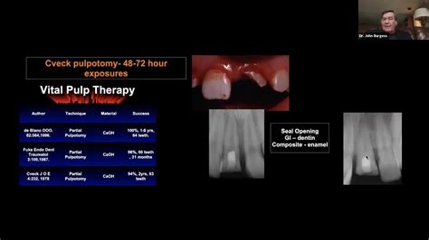 Selective Caries Removal_ Increase Pulpal Vitality, Reduce Post-Op Pain, & Boost Restoration ...