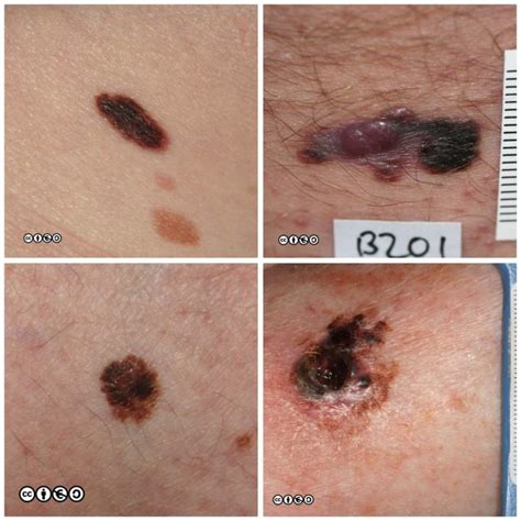 Melanoma - Skin Cancer 909