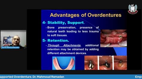 Tooth Supported Overdenture. Part 1: Advantages, Disadvantages, Indications & Contraindications ...