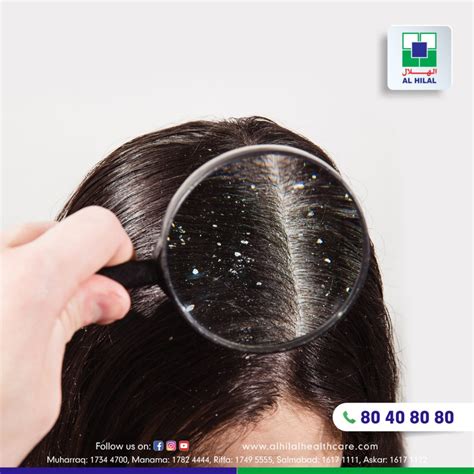 What is Dandruff? Symptoms, Causes, Diagnosis & Treatment