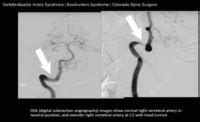 Vertebrobasilar Artery Syndrome | Vertebrobasilar Artery Ischemia ...