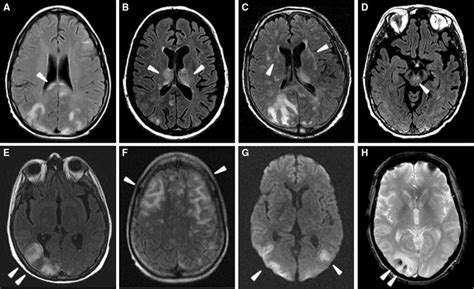 Atypical PRES pattern on brain MRI. a Axial images with T2/FLAIR... | Download Scientific Diagram