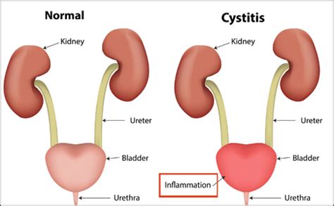 Herbal Remedies for Cystitis, Ayurvedic Treatment - Causes & Symptoms