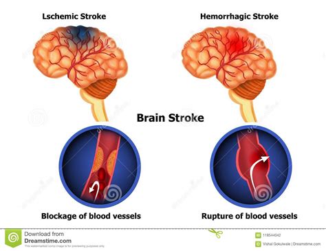 Brain Complications