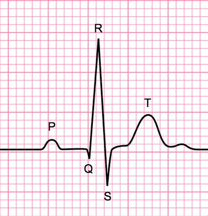 The Basics of ECG Interpretation (Part 2 – Rate, Rhythm and Axis ...