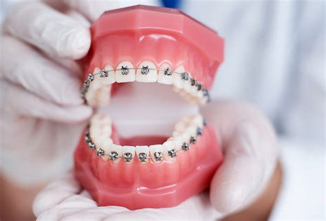 traditional metal braces Houston Texas