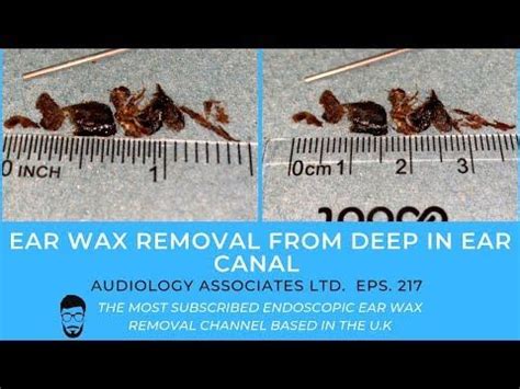 EAR WAX REMOVAL FROM DEEP IN EAR CANAL - EP 217 - YouTube | Ear wax ...