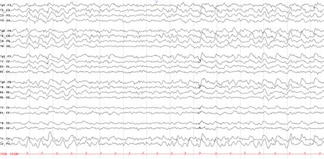 The Normal Asleep EEG