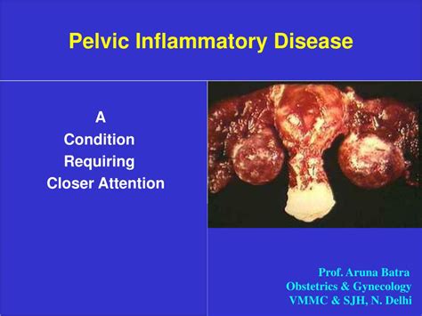 PPT - Pelvic Inflammatory Disease PowerPoint Presentation, free download - ID:154428