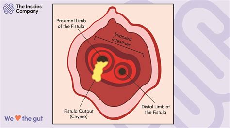 What is an Enterocutaneous Fistula and Enteroatmospheric Fistula?