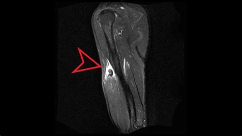 Arm MRI: Tear of Long Head of Biceps Tendon - YouTube