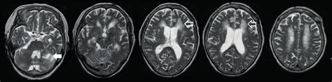 T2-weighted MRI. (A) Case 1: Image shows severe brain atrophy in the... | Download Scientific ...